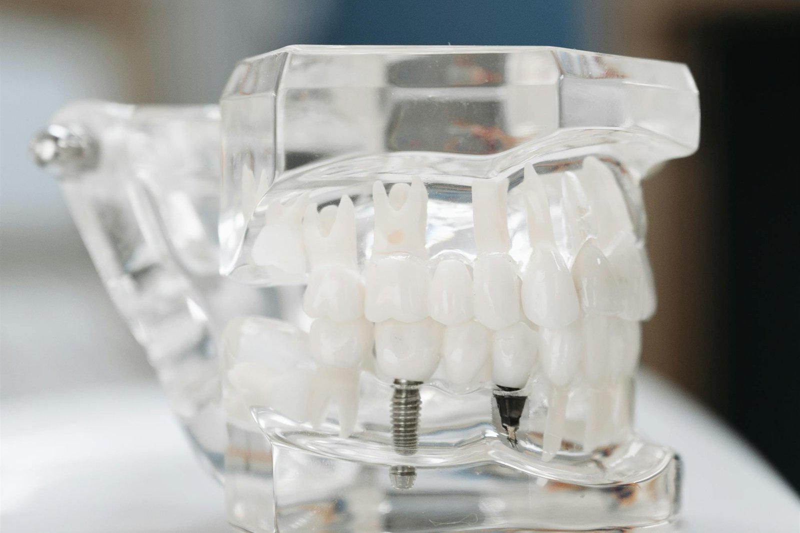 implantologia dentale e impianti dentali a Salerno