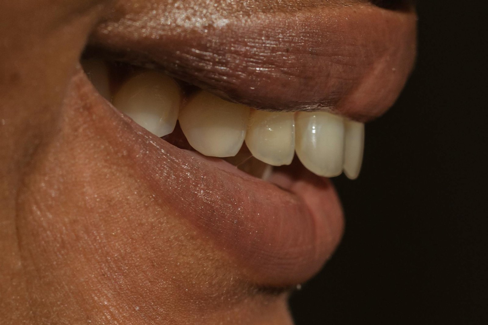 sbiancamento dentale professionale a Salerno